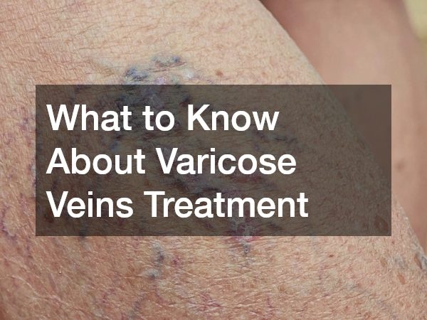 What to Know About Varicose Veins Treatment