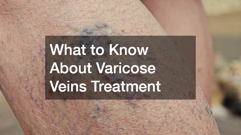 What to Know About Varicose Veins Treatment
